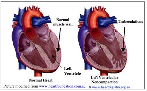 left ventricular non compaction symptoms